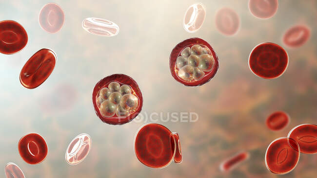 Glóbulos sanguíneos y Plasmodium sp. parásitos (en la etapa de esquizontes) que causan malaria, ilustración por computadora
. - foto de stock