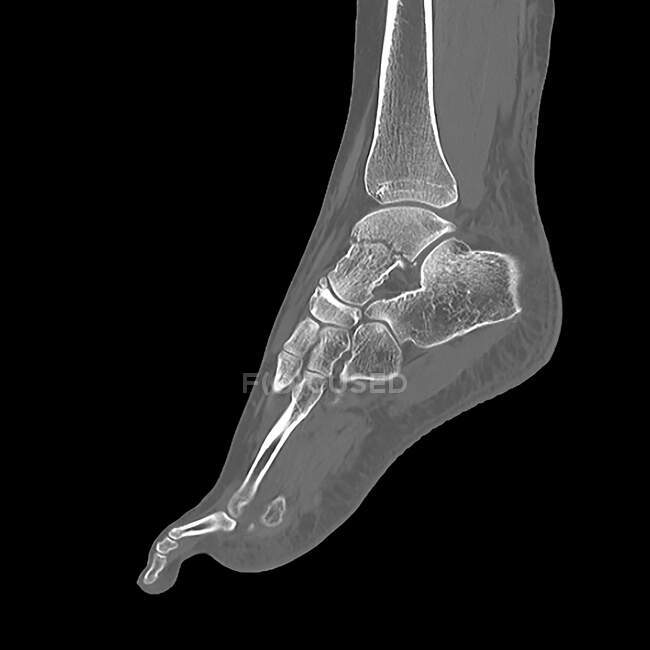 Fractured ankle bone, computer illustration — Stock Photo