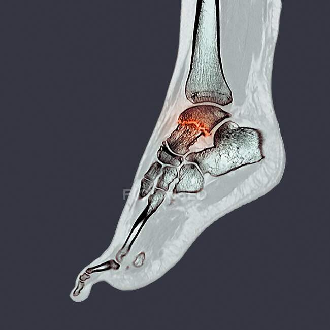 Fractured ankle bone, computer illustration — Stock Photo
