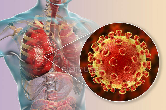 Coronavirus causantes de neumonía, ilustración conceptual por ordenador - foto de stock