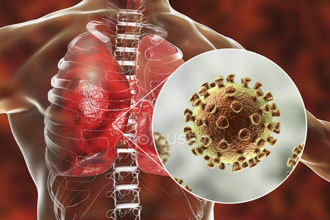 Коронавирусы, вызывающие пневмонию, концептуальная компьютерная иллюстрация — стоковое фото