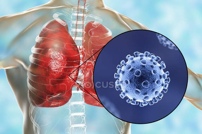 Coronavirus causant une pneumonie, illustration conceptuelle par ordinateur — Photo de stock