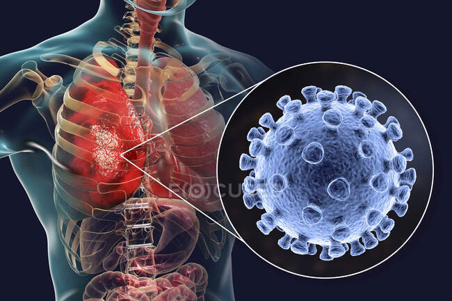 Coronavirus causantes de neumonía, ilustración conceptual por ordenador - foto de stock