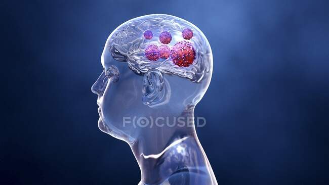 Brain cancer, conceptual computer illustration — Stock Photo