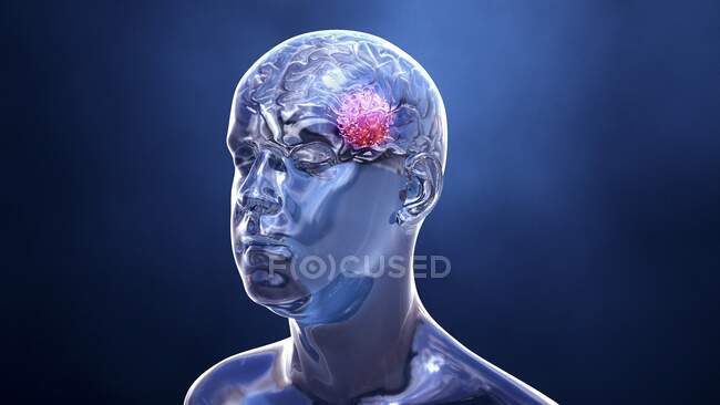 Cancro al cervello, illustrazione concettuale del computer — Foto stock