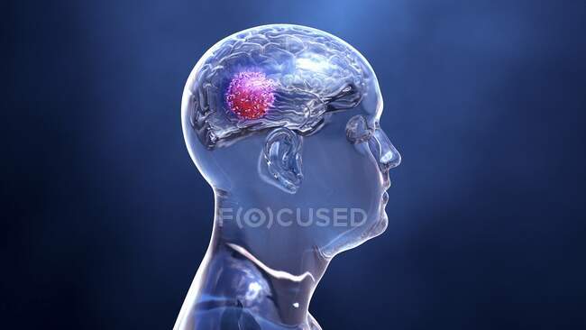 Cáncer cerebral, ilustración conceptual por ordenador - foto de stock
