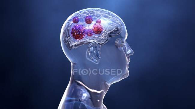 Cáncer cerebral, ilustración conceptual por ordenador - foto de stock