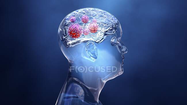Рак мозга, концептуальная компьютерная иллюстрация — стоковое фото
