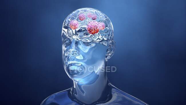 Рак мозку, комп'ютерна ілюстрація — стокове фото