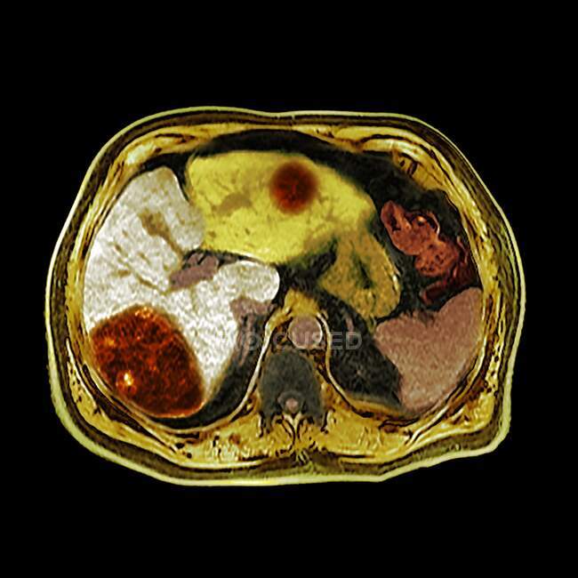 Cancer du foie. Tomodensitométrie axiale colorée (tomodensitométrie) dans l'abdomen d'un homme de 80 ans atteint d'un cancer du foie. Le foie est au centre gauche. — Photo de stock