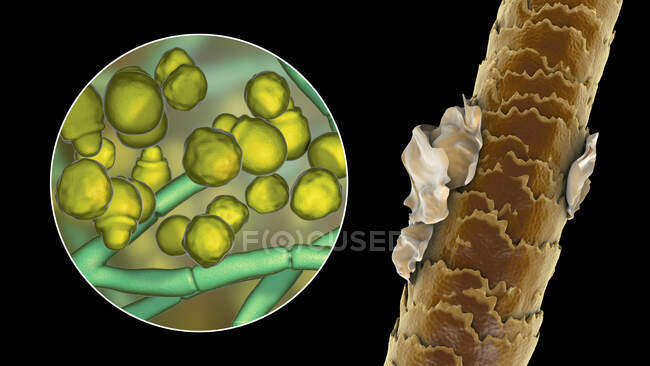 Комп'ютерна ілюстрація, що показує людське волосся з дендрафом і вигляд мікроскопічного гриба Malassezia furfur, пов'язаного з себорроєвим дерматитом і дендрафтовою формацією — стокове фото