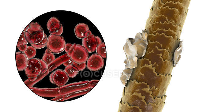 Computer illustration showing human hair with dandruff and close-up view of microscopic fungi Malassezia furfur associated with seborrhoeic dermatitis and dandruff formation — Stock Photo