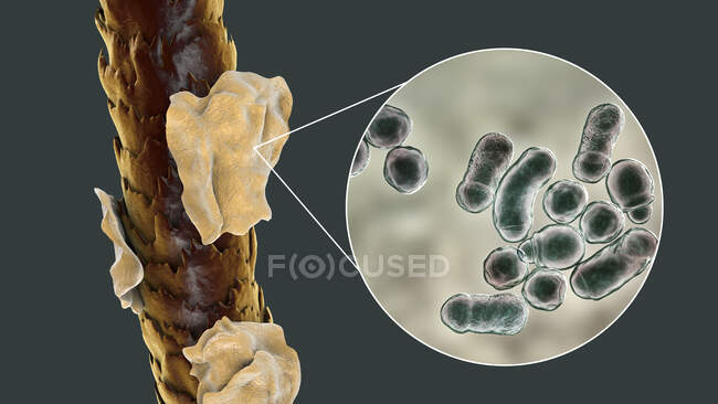 Комп'ютерна ілюстрація, що показує людське волосся з дендрафом і вигляд мікроскопічного гриба Malassezia furfur, пов'язаного з себорроєвим дерматитом і дендрафтовою формацією — стокове фото