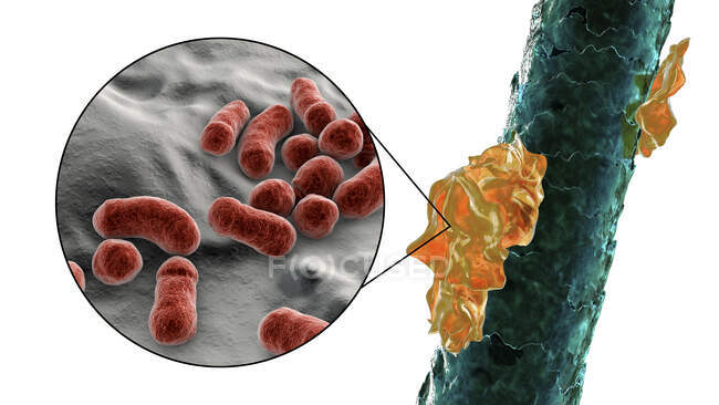 Ilustración por computadora que muestra el cabello humano con caspa y vista de cerca de hongos microscópicos Malassezia furfur asociado con la dermatitis seborreica y la formación de caspa - foto de stock