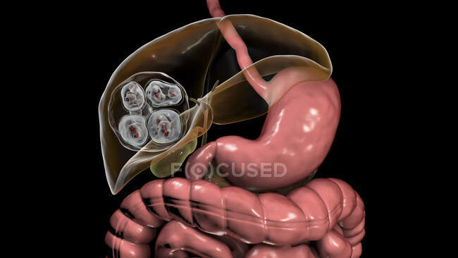 Hydatid disease in liver caused by larvae of parasitic tapeworm Echinococcus multilocularis, computer illustration — Stock Photo
