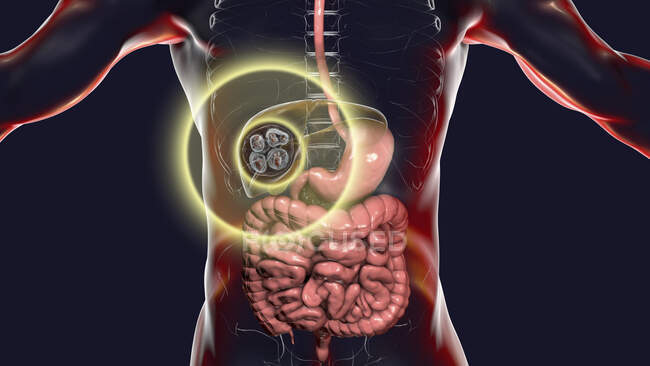 Enfermedad hidatídica en el hígado causada por larvas de tenia parasitaria Echinococcus multilocularis, ilustración por ordenador - foto de stock