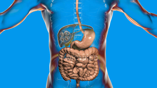 Malattia idatica nel fegato causata da larve di tenia parassitaria Echinococcus multilocularis, illustrazione al computer — Foto stock