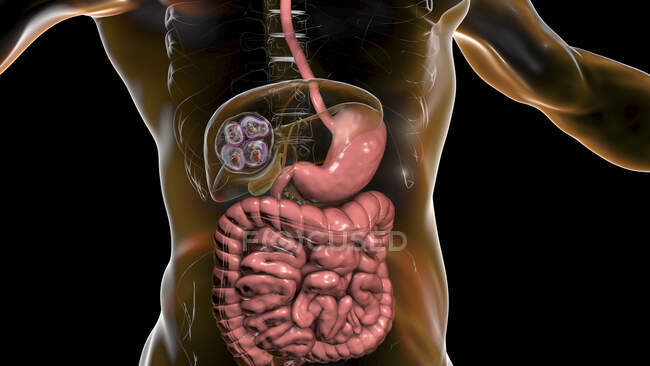 Enfermedad hidatídica en el hígado causada por larvas de tenia parasitaria Echinococcus multilocularis, ilustración por ordenador - foto de stock