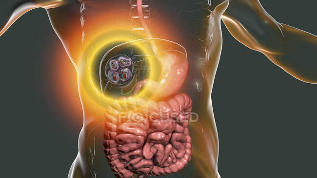 Хвороба гідатид у печінці, спричинена личинками паразитичного тепехробака Echinococcus multilocularis, комп 