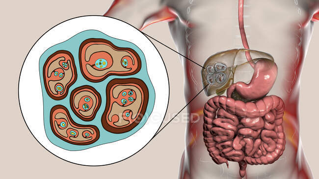 Гидатидные заболевания печени, вызванные личинками паразитического ленточного червя Echinococcus multilocularis, компьютерная иллюстрация — стоковое фото