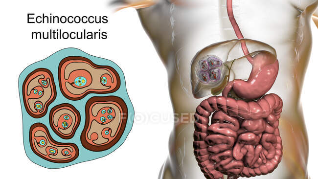 Hydatid disease in liver caused by larvae of parasitic tapeworm Echinococcus multilocularis, computer illustration — Stock Photo
