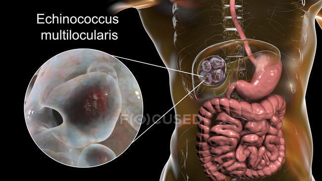 Lebererkrankung durch Larven des parasitären Bandwurms Echinococcus multilocularis, Computerillustration — Stockfoto