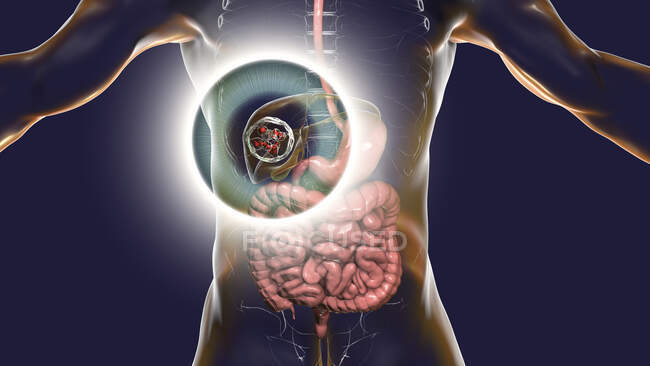 Гідратидна хвороба в печінці, кістозний ехінокоз, Комп'ютерна ілюстрація — стокове фото