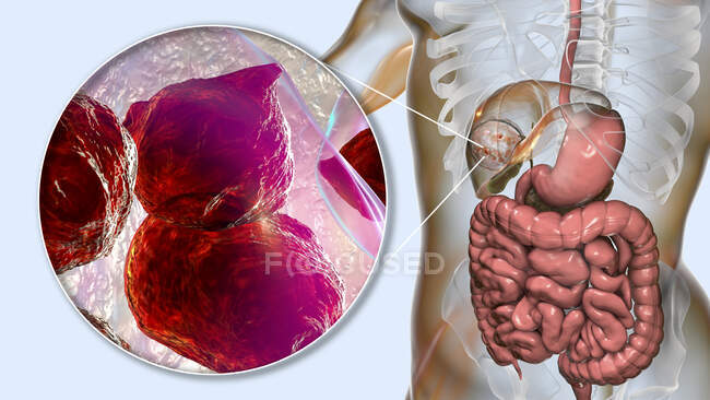 Enfermedad hidatídica en el hígado, equinococosis quística, ilustración por ordenador - foto de stock