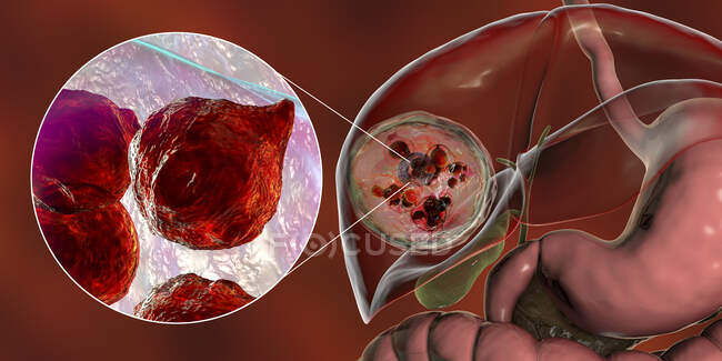Malattia idatica nel fegato, echinococcosi cistica, Illustrazione computerizzata — Foto stock