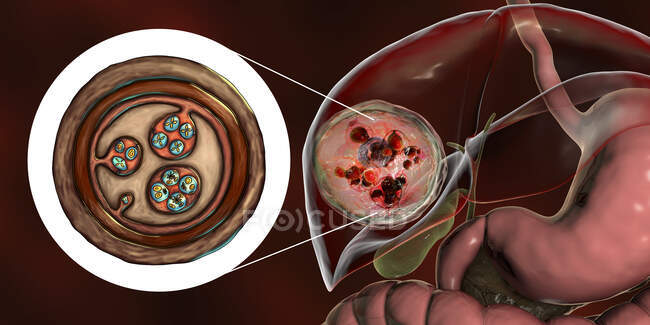 Hydatid disease in liver, cystic echinococcosis, Computer illustration — Stock Photo