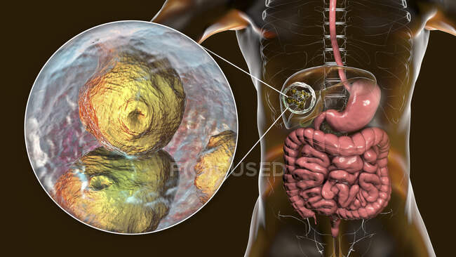 Hydatid-Krankheit in der Leber, zystische Echinokokkose, Computerillustration — Stockfoto