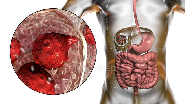 Гидатидные заболевания печени, кистозный эхинококкоз, Компьютерная иллюстрация — стоковое фото
