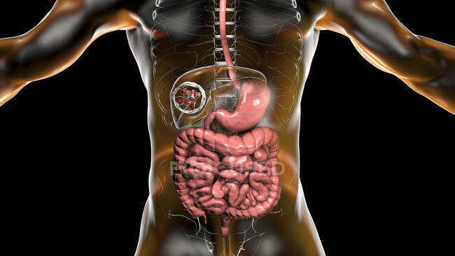 Гидатидные заболевания печени, кистозный эхинококкоз, Компьютерная иллюстрация — стоковое фото