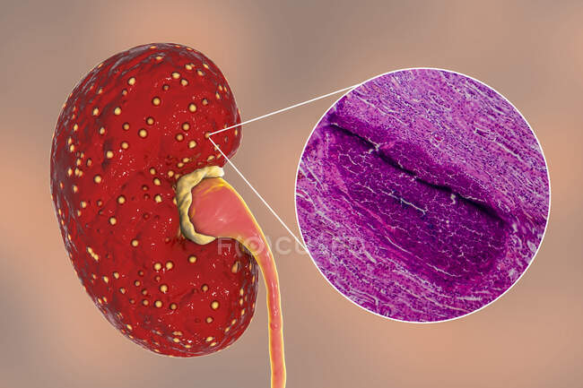 Pielonefritis aguda, ilustración por ordenador y micrografía ligera - foto de stock