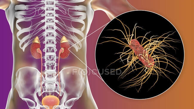Гострий пієлонефрит. Ілюстрація дрібних абсцесів (жовтих) на поверхні нирки при гострому пієлонефриті — стокове фото