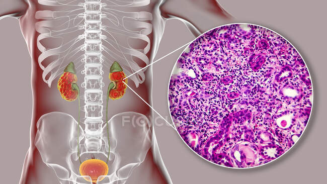 Pielonefritis crónica, ilustración por ordenador y micrografía ligera - foto de stock