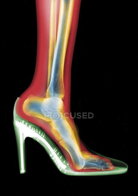 Leg in stiletto shoe, coloured MRI style X-ray. — Stock Photo