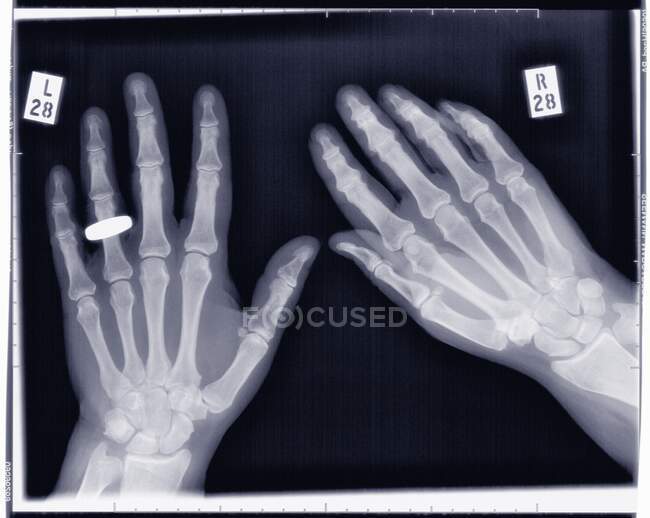 Mani con fede nuziale sulla mano sinistra, radiografia. — Foto stock