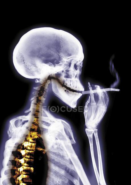 Person smoking, coloured X-ray. — Stock Photo