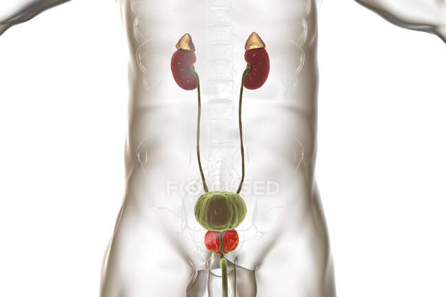 Ilustração da hiperplasia benigna da próstata. Hiperplasia é o crescimento excessivo de células normais, o que leva à formação de nódulos — Fotografia de Stock