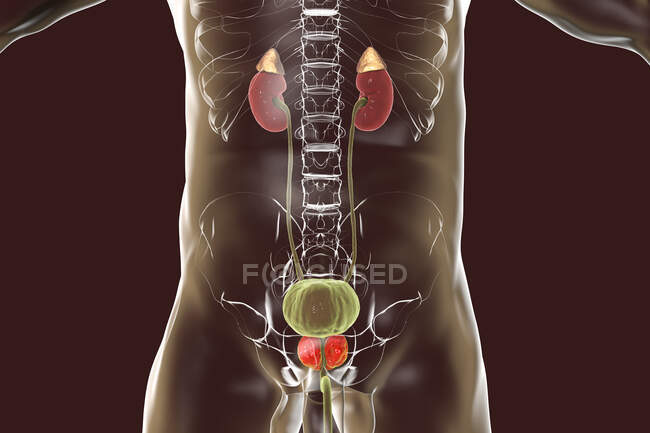 Ilustração da hiperplasia benigna da próstata. Hiperplasia é o crescimento excessivo de células normais, o que leva à formação de nódulos — Fotografia de Stock