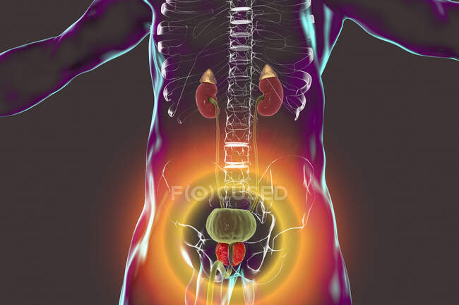 Illustration d'une hyperplasie bénigne de la prostate. Hyperplasie est la croissance excessive des cellules normales, ce qui conduit à la formation de nodules — Photo de stock