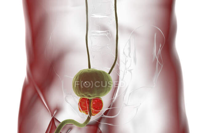 Illustration d'une hyperplasie bénigne de la prostate. Hyperplasie est la croissance excessive des cellules normales, ce qui conduit à la formation de nodules — Photo de stock