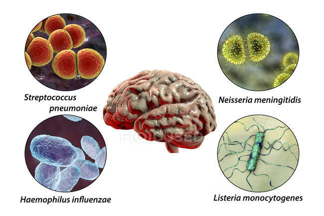 Причины бактериального менингита, компьютерная иллюстрация. Основными возбудителями бактериального менингита являются бактерии Ssseria meningitidis, Streptococcus pneumoniae, Haemophilus influfae и Listeria monocytogenes. Меченое изображение. — стоковое фото
