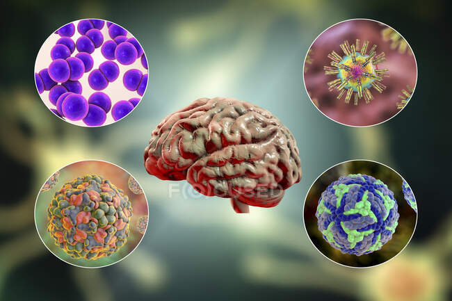 Инфекции мозга. Компьютерная иллюстрация микроорганизмов, вызывающих энцефалит и менингит — стоковое фото