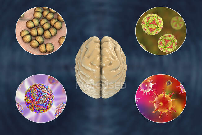 Infecciones cerebrales. Ilustración informática de microorganismos que causan encefalitis y meningitis - foto de stock