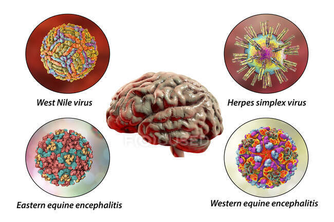 Infecciones cerebrales. Ilustración informática de microorganismos que causan encefalitis y meningitis - foto de stock