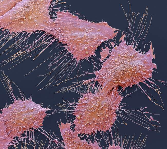 Células cancerosas ósseas. Micrografia eletrônica de varredura colorida de células de câncer de osteossarcoma. O osteossarcoma é uma neoplasia maligna agressiva decorrente de células mesenquimais transformadas primitivas — Fotografia de Stock