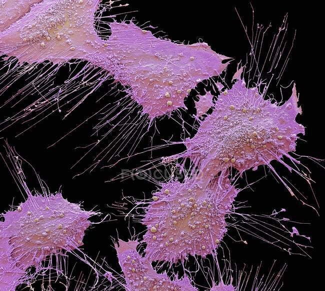 Células cancerosas ósseas. Micrografia eletrônica de varredura colorida de células de câncer de osteossarcoma. O osteossarcoma é uma neoplasia maligna agressiva decorrente de células mesenquimais transformadas primitivas — Fotografia de Stock