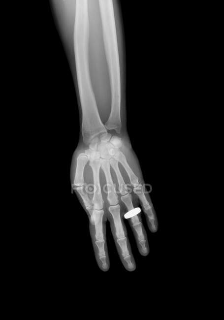 Hand with jewellery, X-ray. — Stock Photo